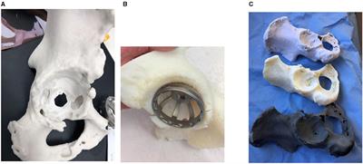 3D Printed Patient-Specific Complex Hip Arthroplasty Models Streamline the Preoperative Surgical Workflow: A Pilot Study